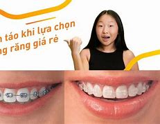 Chi Phí Niềng Răng Ở Nhật